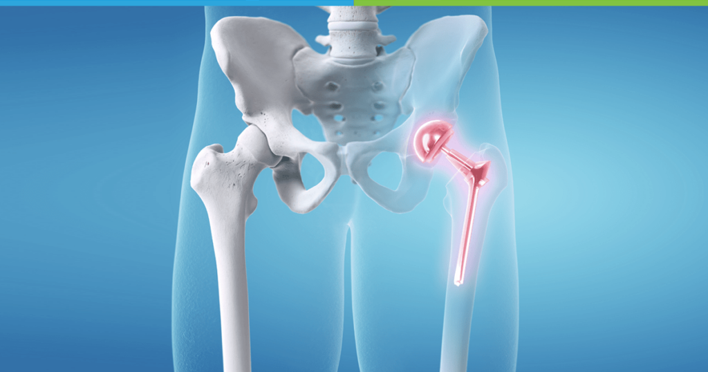 Advanced Hip Replacement Surgery