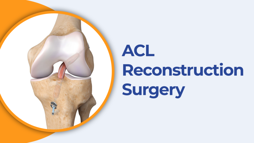 Best ACL Reconstruction Surgery