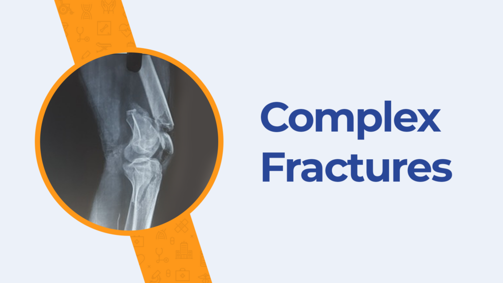 Best Treatment for Complex Fractures