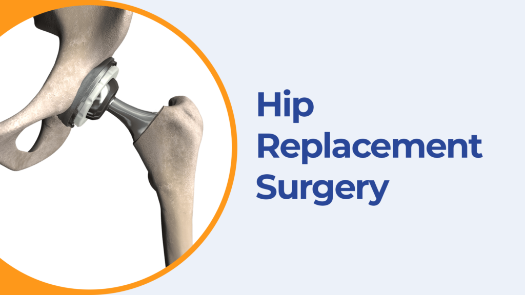 Best Hip Replacement Surgery
