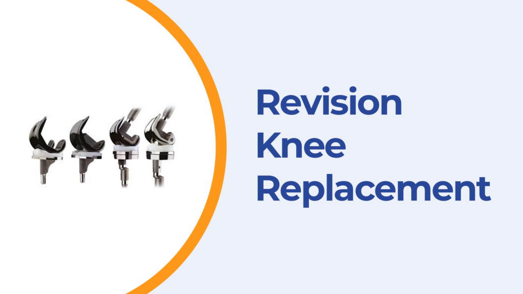 Best Revision Knee Replacement