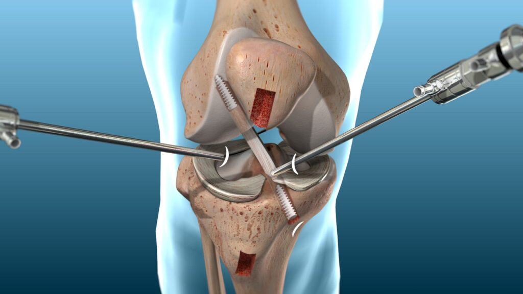 ACL Reconstruction Surgery in Hyderabad