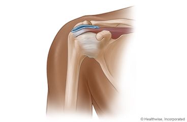 Labral Tear Shoulder Treatment in Hyderabad