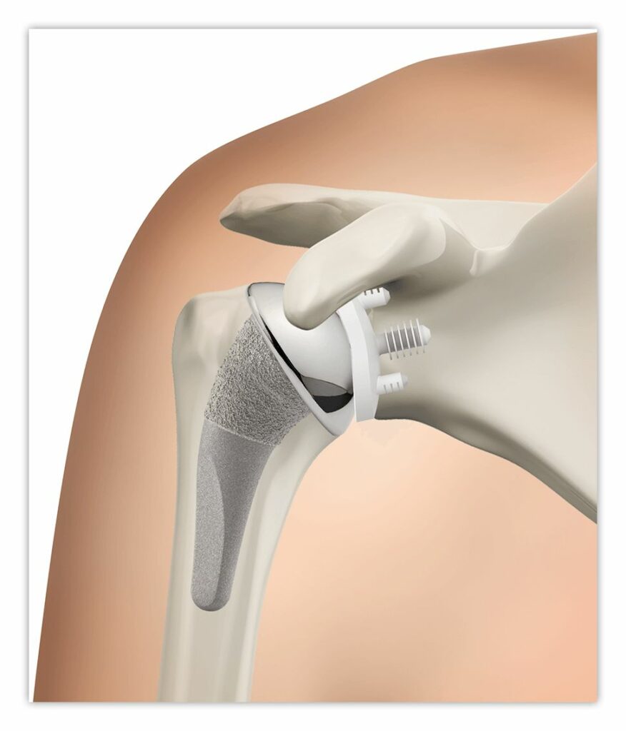 Shoulder Replacement Surgery in Hyderabad