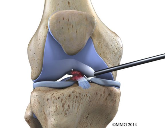 PCL Reconstruction Surgery in Hyderabad