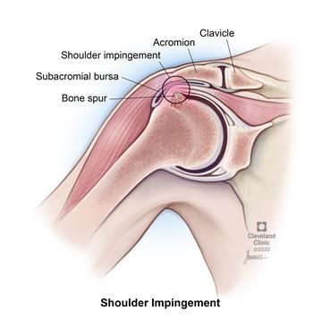Shoulder Impingement Treatment in Hyderabad