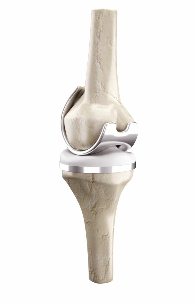Total Knee Replacement Surgery in Hyderabad