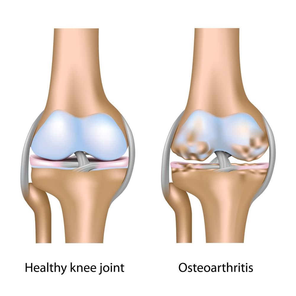 Osteoarthritis Treatment in Hyderabad