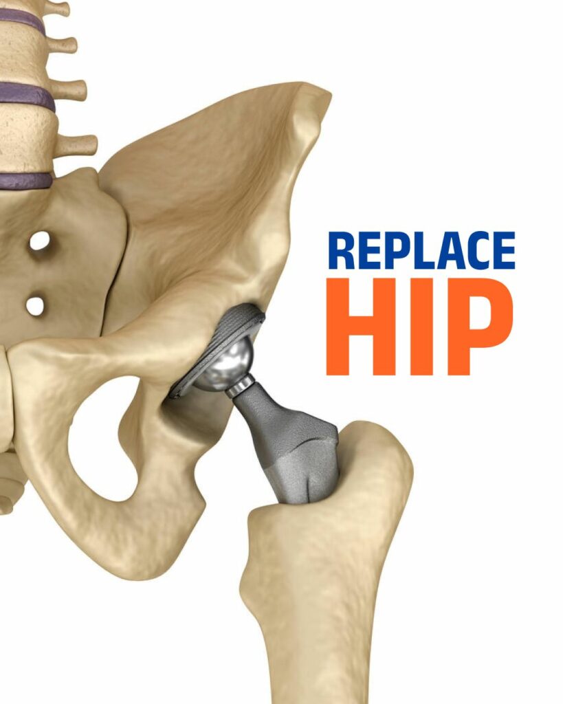 Total Hip Replacement Surgery in Hyderabad - Robotic