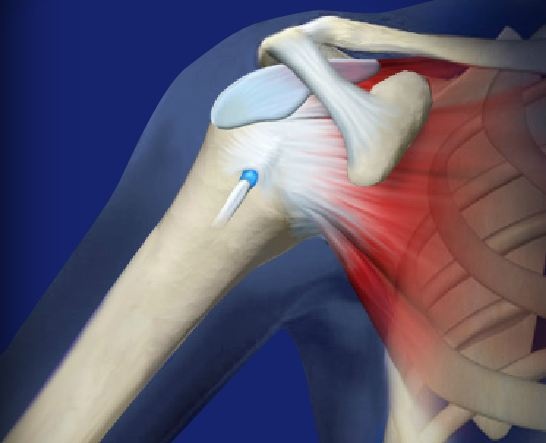 Labral Tear Shoulder Treatment in Hyderabad