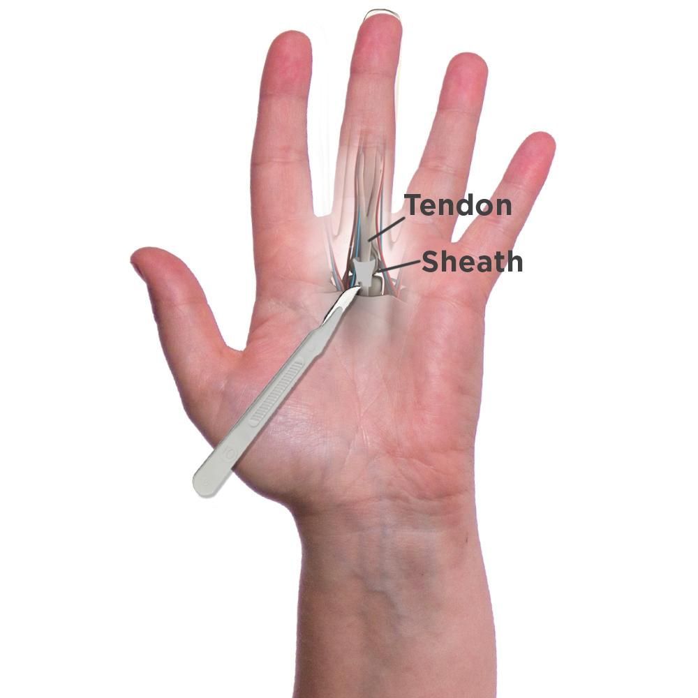 Trigger Finger Release Surgery in Hyderabad
