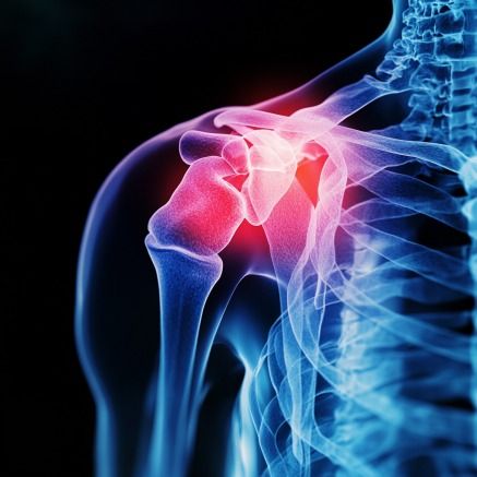Shoulder Impingement Treatment in Hyderabad