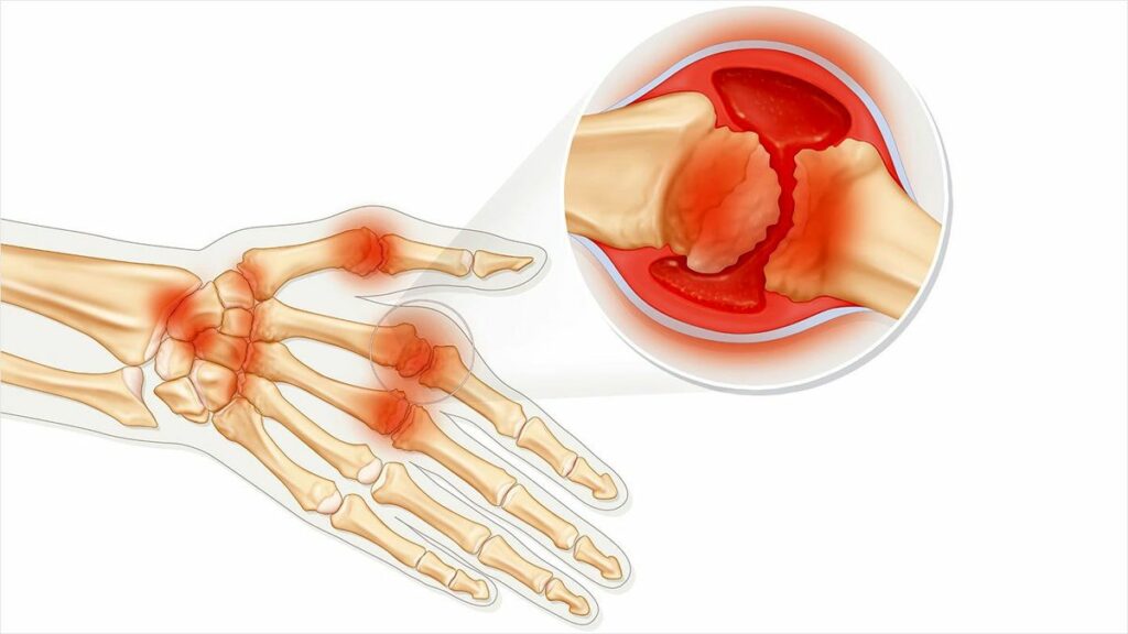 Rheumatoid Arthritis Treatment in Hyderabad