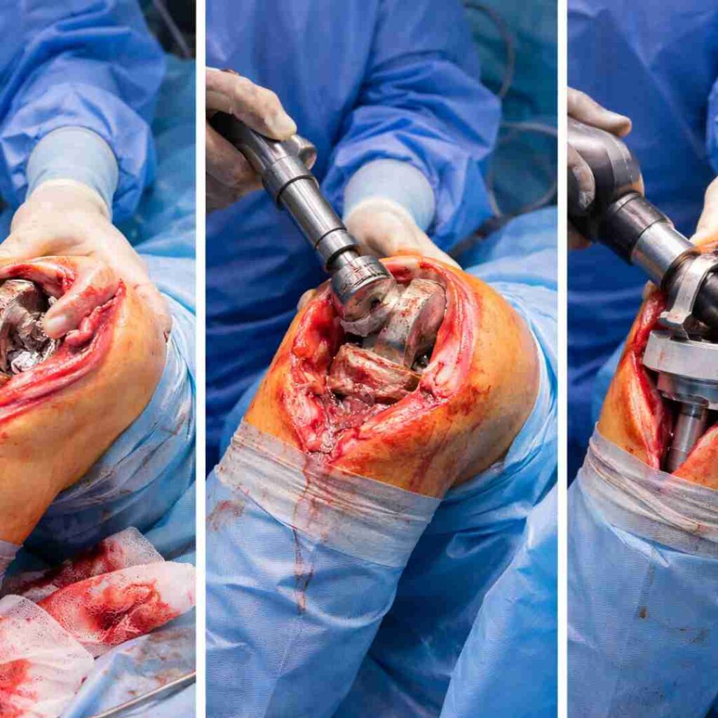 Knee Revision surgery in Hyderabad