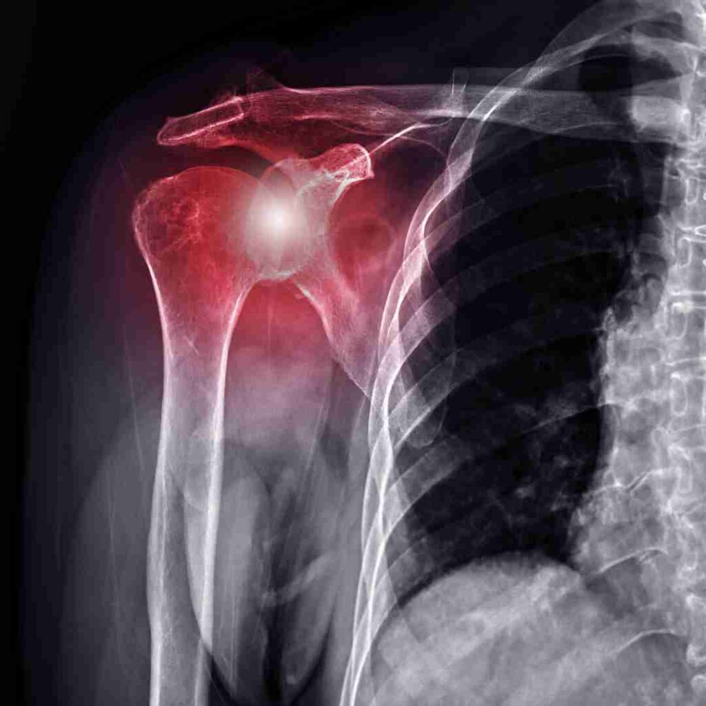 AC Joint Fixation Surgery in Hyderabad