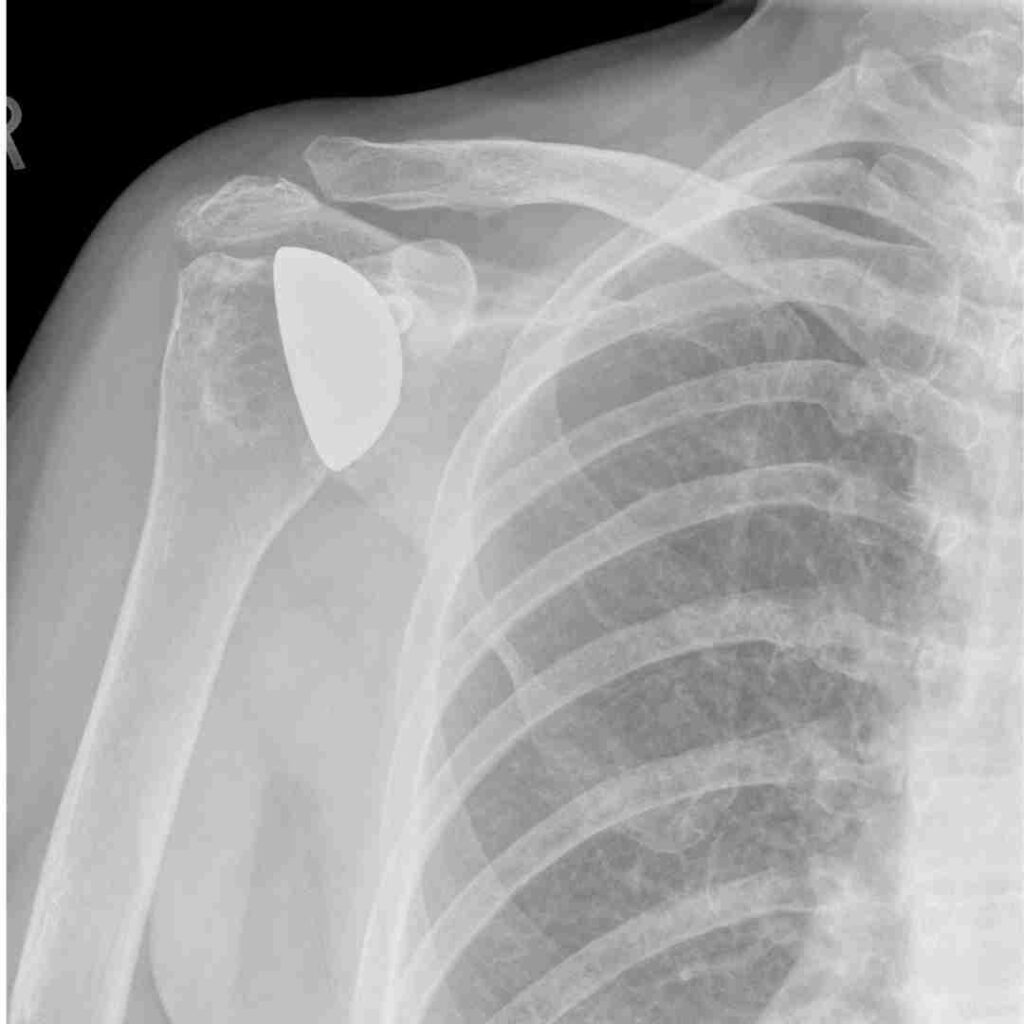 AC Joint Fixation Surgery in Hyderabad