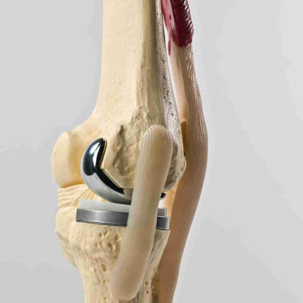 Knee Revision surgery in Hyderabad