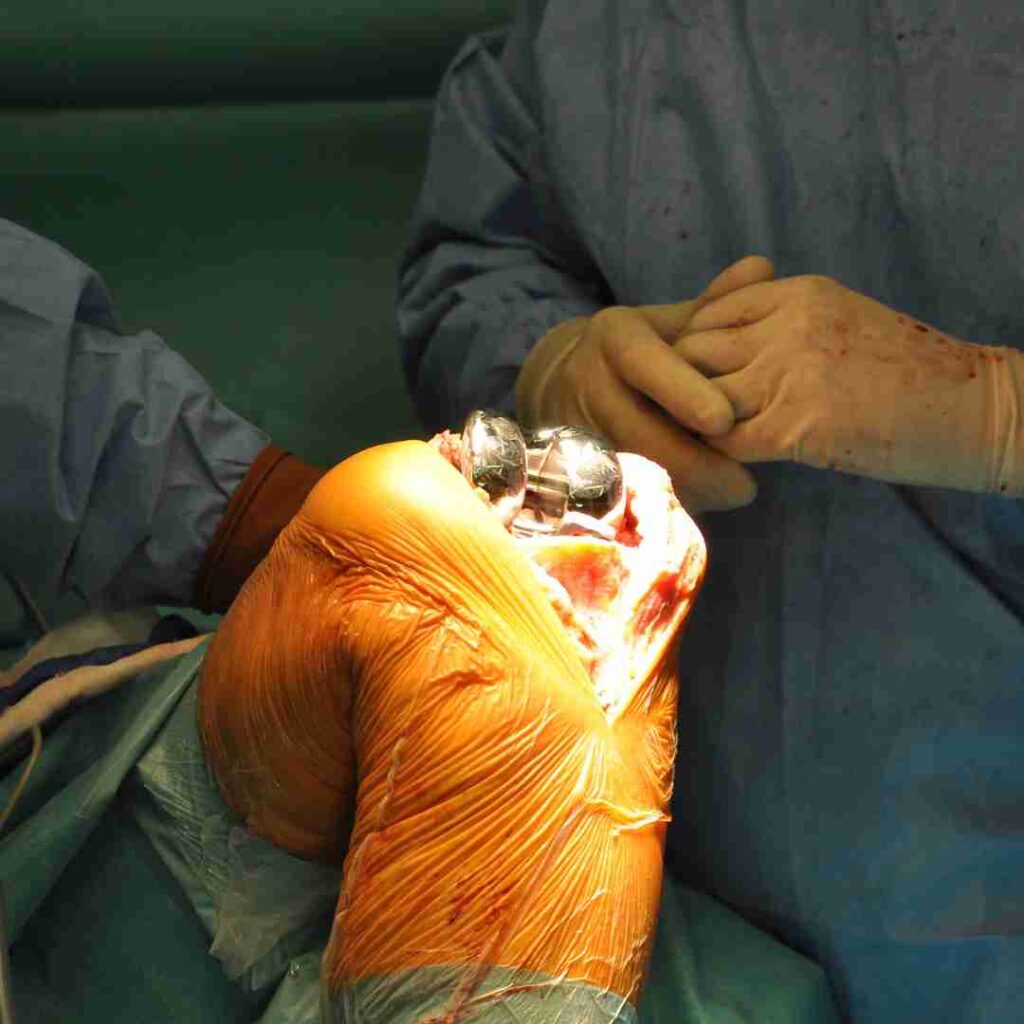 Knee Replacement Surgery in Hyderabad