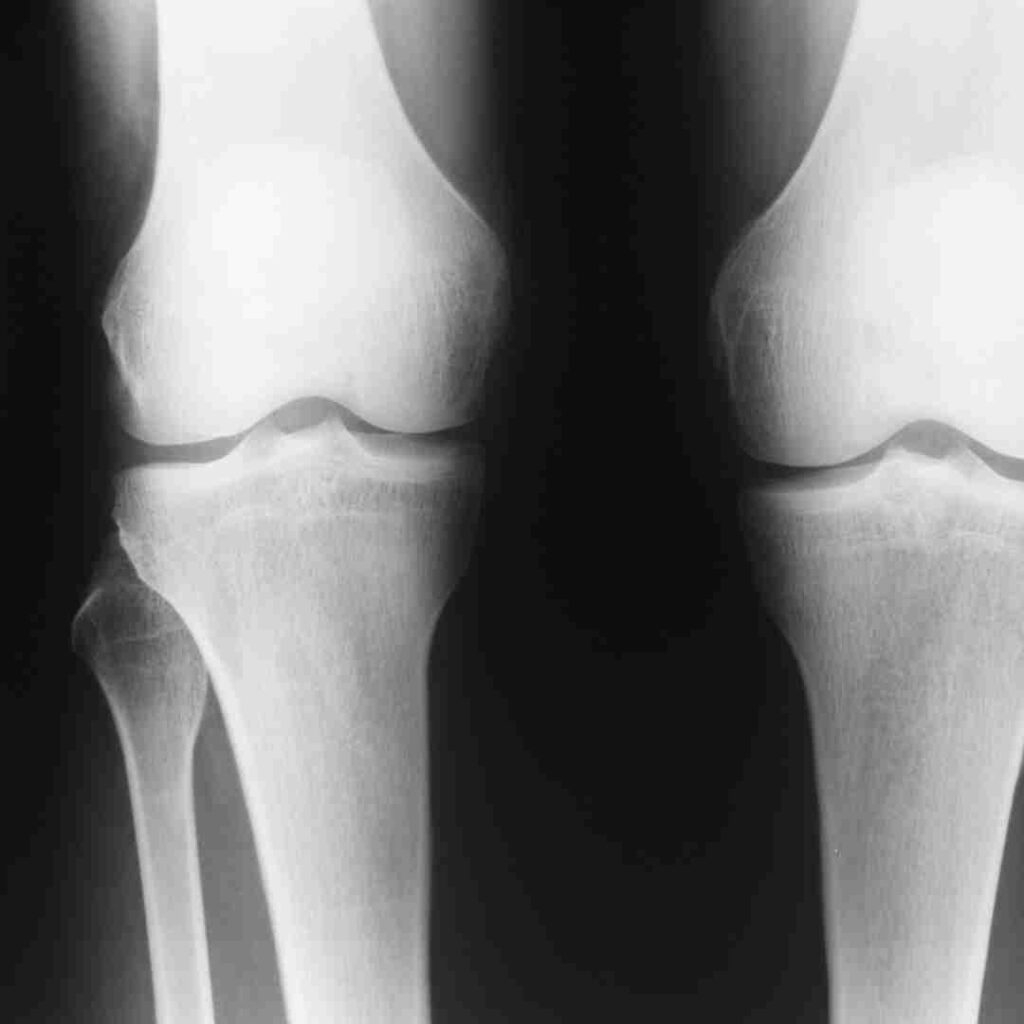 Knee Revision surgery in Hyderabad