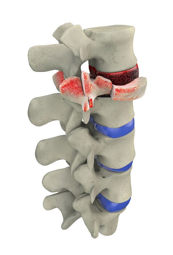 Spinal Fusion Surgery In Hyderabad