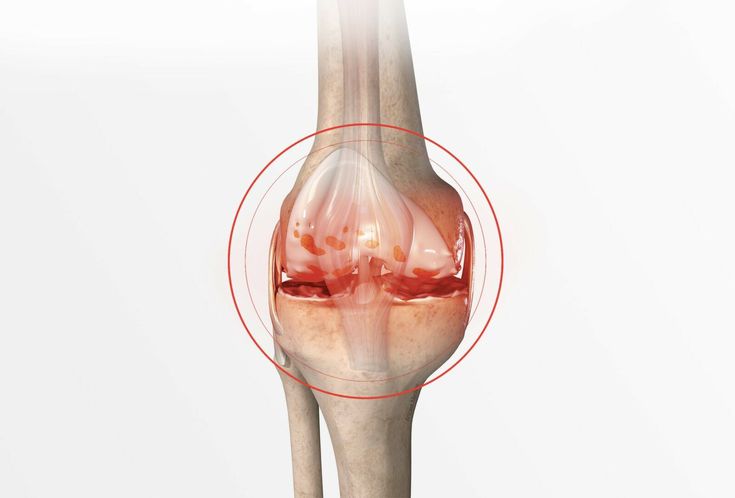 Osteoarthritis Treatment in Hyderabad