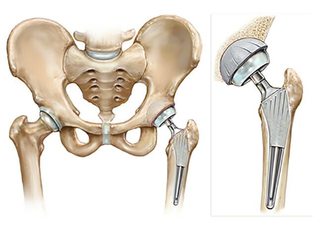 Total Hip Replacement Surgery in Hyderabad - Robotic
