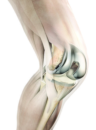 Total Knee Replacement Surgery in Hyderabad