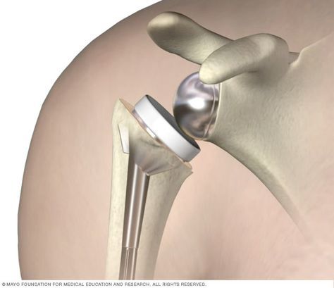 Shoulder Replacement Surgery in Hyderabad