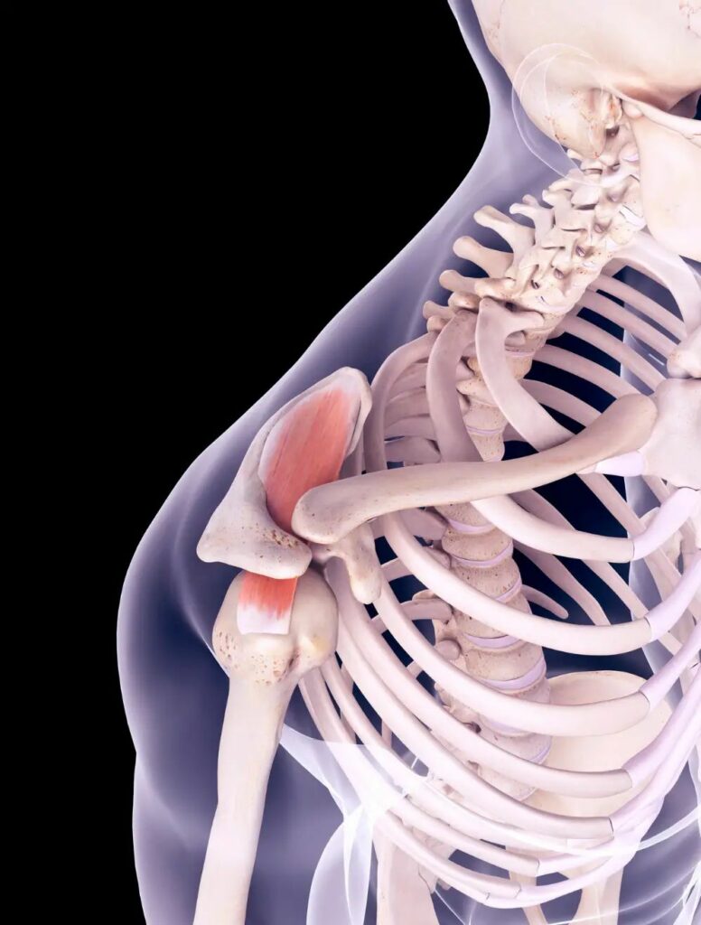 Shoulder Impingement Treatment in Hyderabad