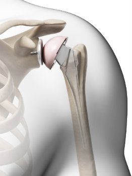 Shoulder Replacement Surgery in Hyderabad