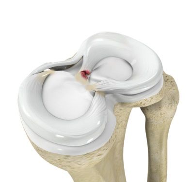 Meniscal Tear Treatment in Hyderabad