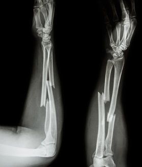 Complex Fracture Treatment in Malakpet