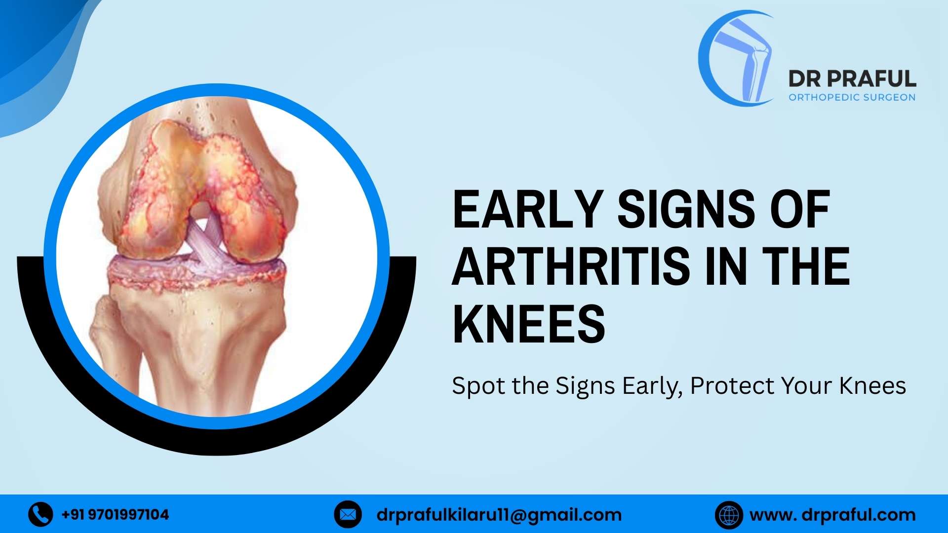 Early Signs of Arthritis in the Knees
