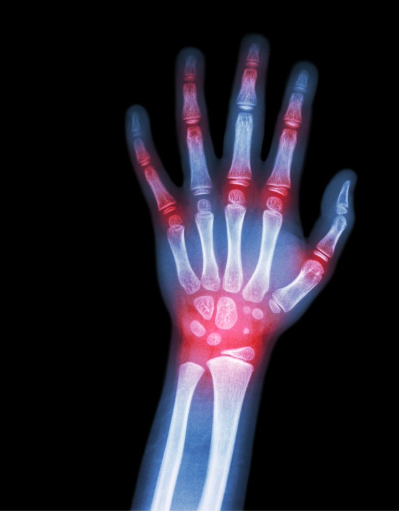 Joint fusion surgery in Malakpet